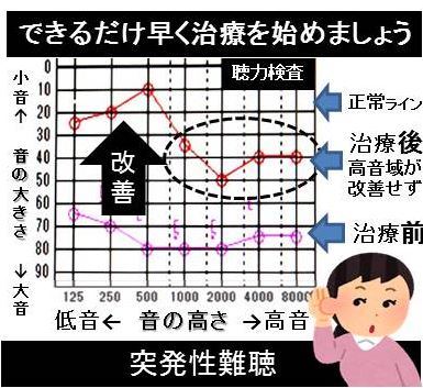 突発性難聴
